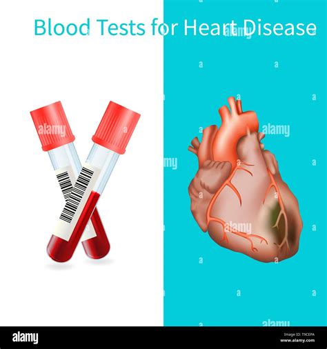 Blood Tests for Heart Disease .